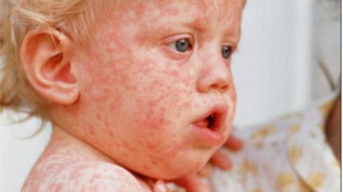 Сыпь после лихорадки у детей – что это?